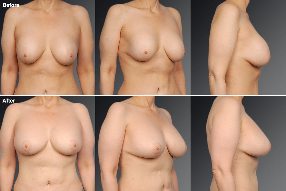 Breast Implant Revision Before & After Gallery - Patient 105534348 - Image 1