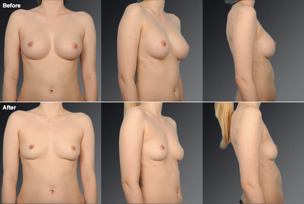 Breast Implant Revision Before & After Gallery - Patient 105534349 - Image 1