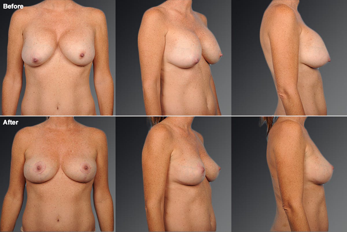 Breast Implant Revision Before & After Gallery - Patient 105534350 - Image 1