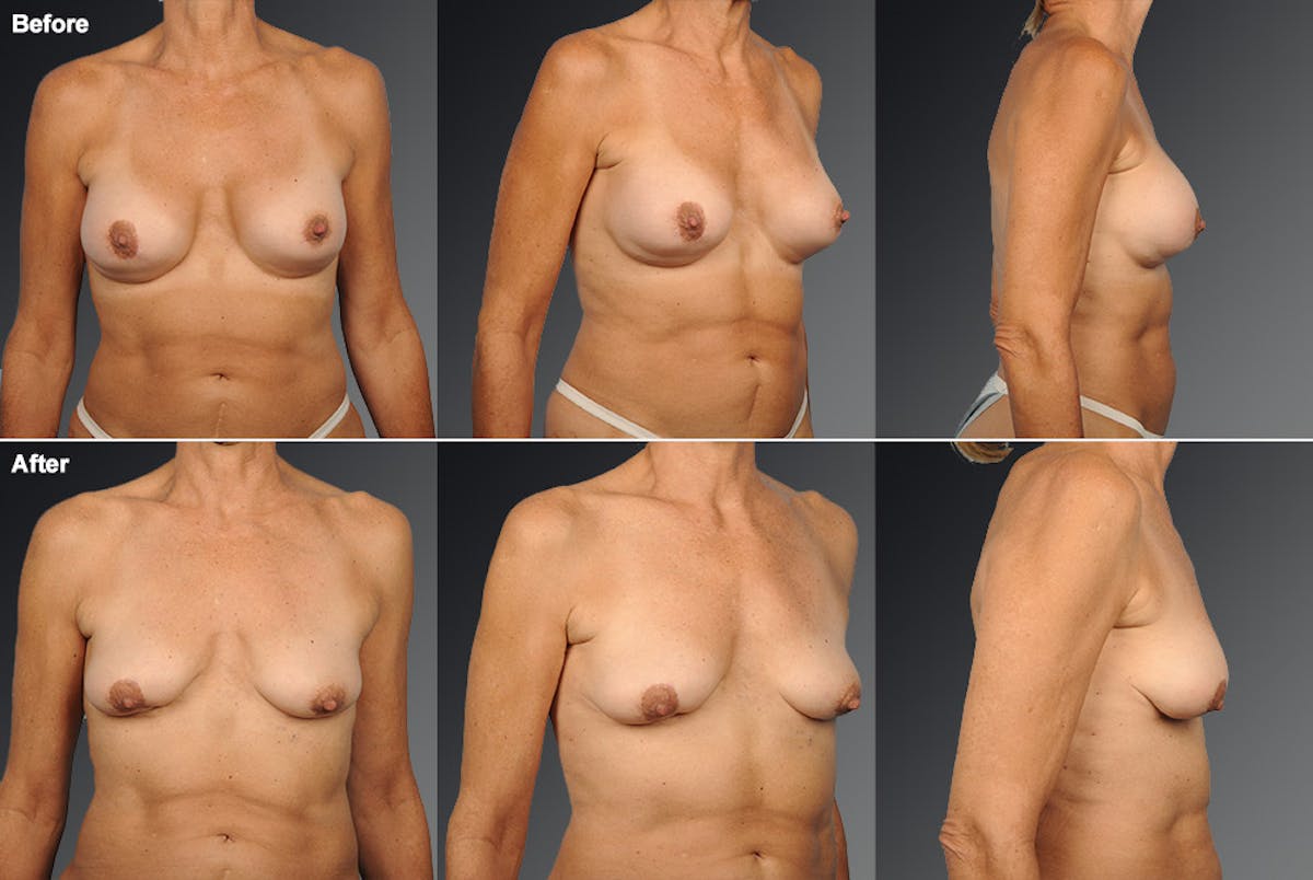 Breast Implant Revision Before & After Gallery - Patient 105534353 - Image 1
