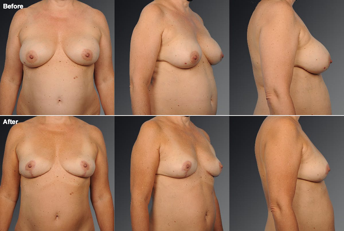 Breast Implant Revision Before & After Gallery - Patient 105534364 - Image 1