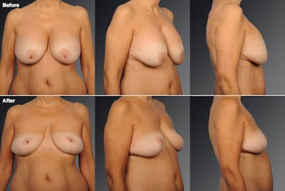 Breast Implant Revision Before & After Gallery - Patient 105534378 - Image 1