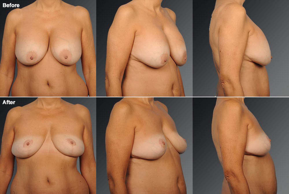 Breast Implant Revision Before & After Gallery - Patient 105534378 - Image 1