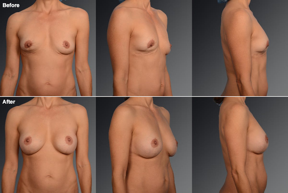Breast Implant Revision Before & After Gallery - Patient 105534382 - Image 1