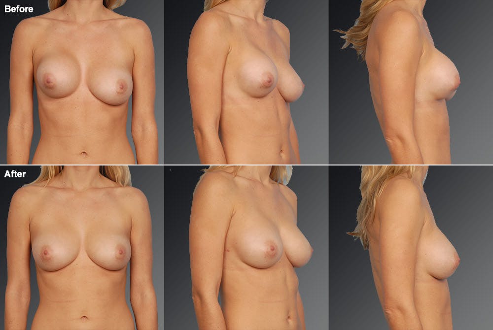 Breast Implant Revision Before & After Gallery - Patient 105534384 - Image 1