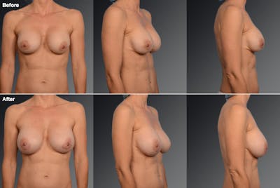 Breast Implant Revision Before & After Gallery - Patient 105534385 - Image 1