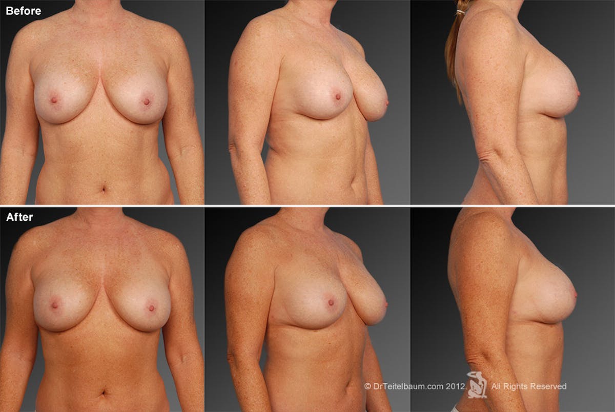 Breast Implant Revision Before & After Gallery - Patient 105534387 - Image 1
