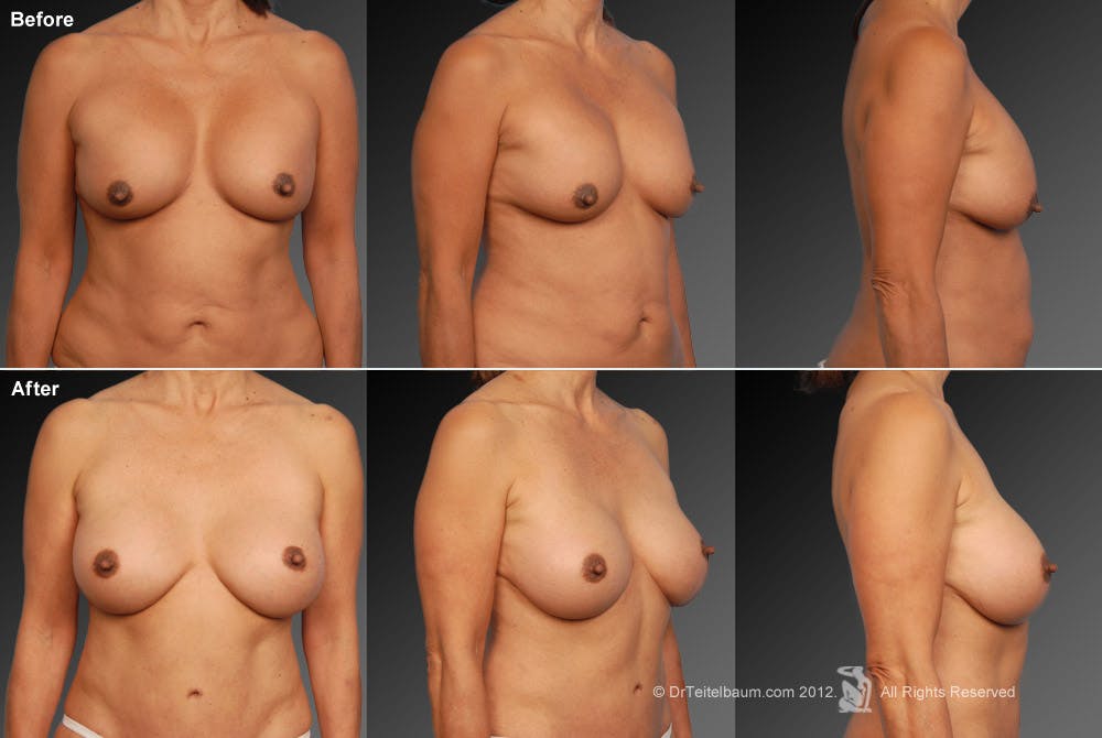 Breast Implant Revision Before & After Gallery - Patient 105534401 - Image 1