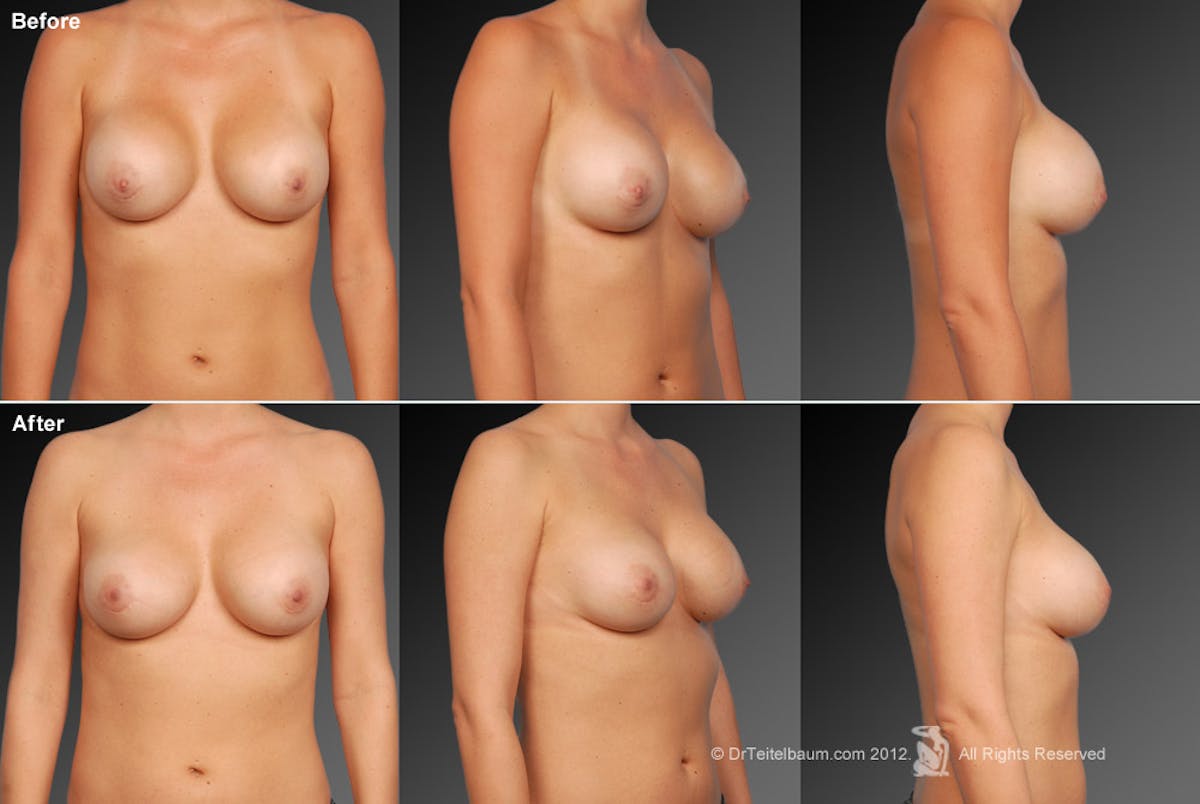 Breast Implant Revision Before & After Gallery - Patient 105534402 - Image 1