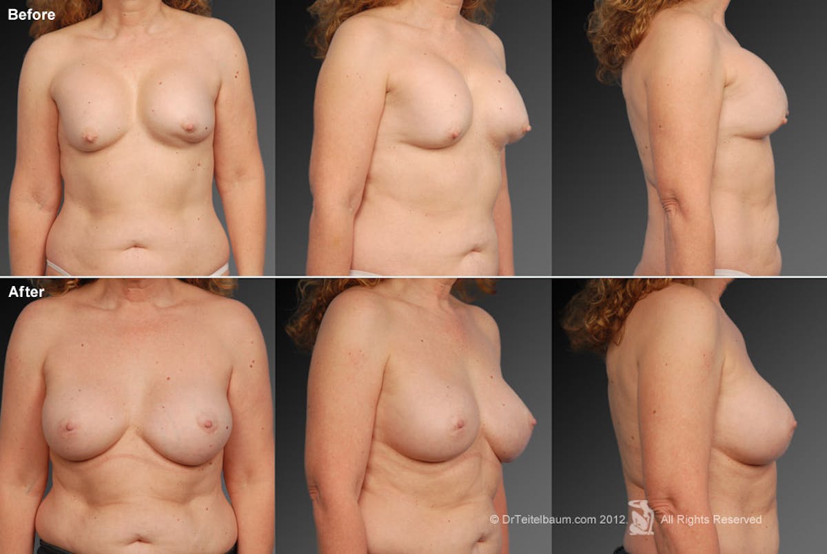 Breast Implant Revision Before & After Gallery - Patient 105534404 - Image 1