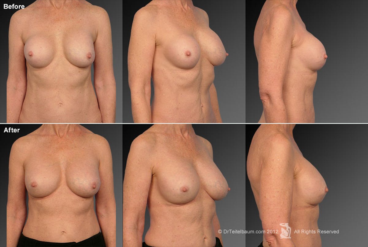 Breast Implant Revision Before & After Gallery - Patient 105534406 - Image 1