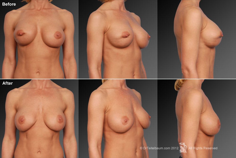 Breast Implant Revision Before & After Gallery - Patient 105534407 - Image 1