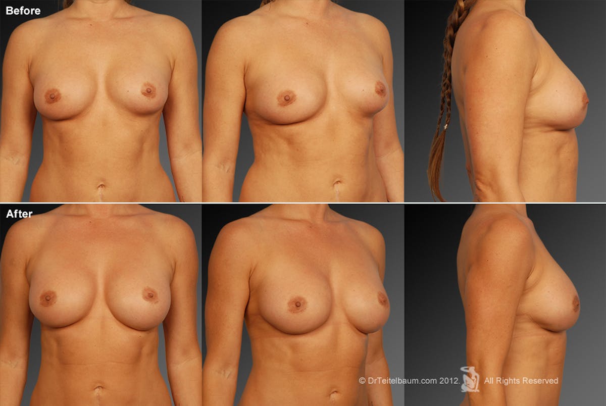 Breast Implant Revision Before & After Gallery - Patient 105534413 - Image 1