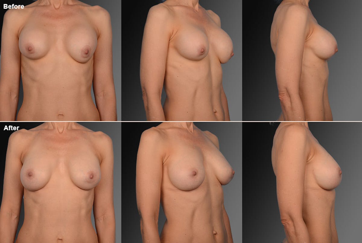 Breast Implant Revision Before & After Gallery - Patient 105534424 - Image 1