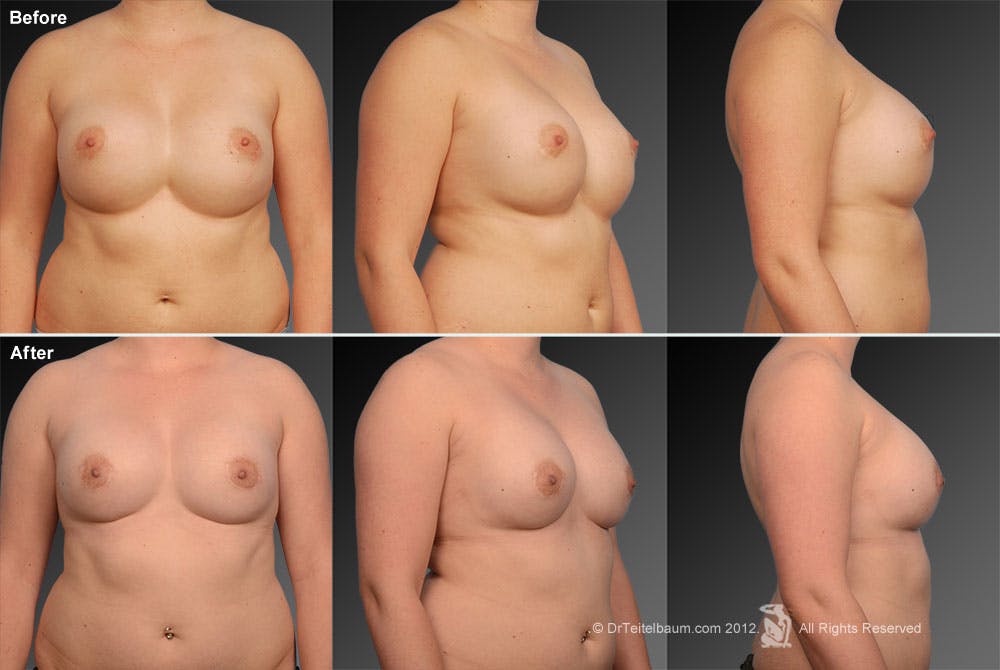 Breast Implant Revision Before & After Gallery - Patient 105536451 - Image 1