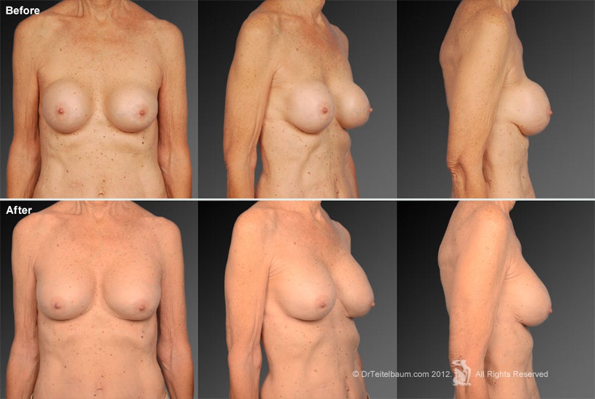 Breast Implant Revision Before & After Gallery - Patient 105536459 - Image 1