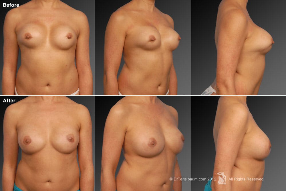 Breast Implant Revision Before & After Gallery - Patient 105536484 - Image 1
