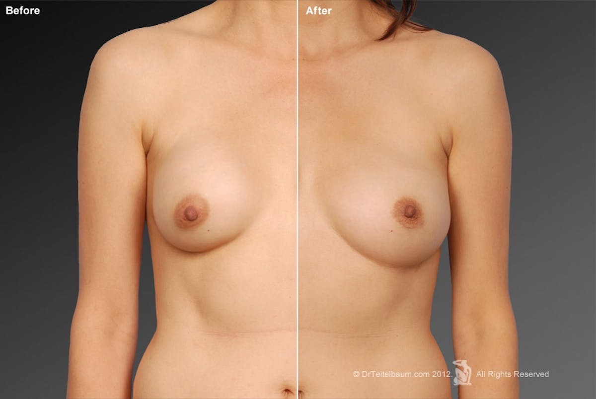 Breast Implant Revision Before & After Gallery - Patient 105536487 - Image 1