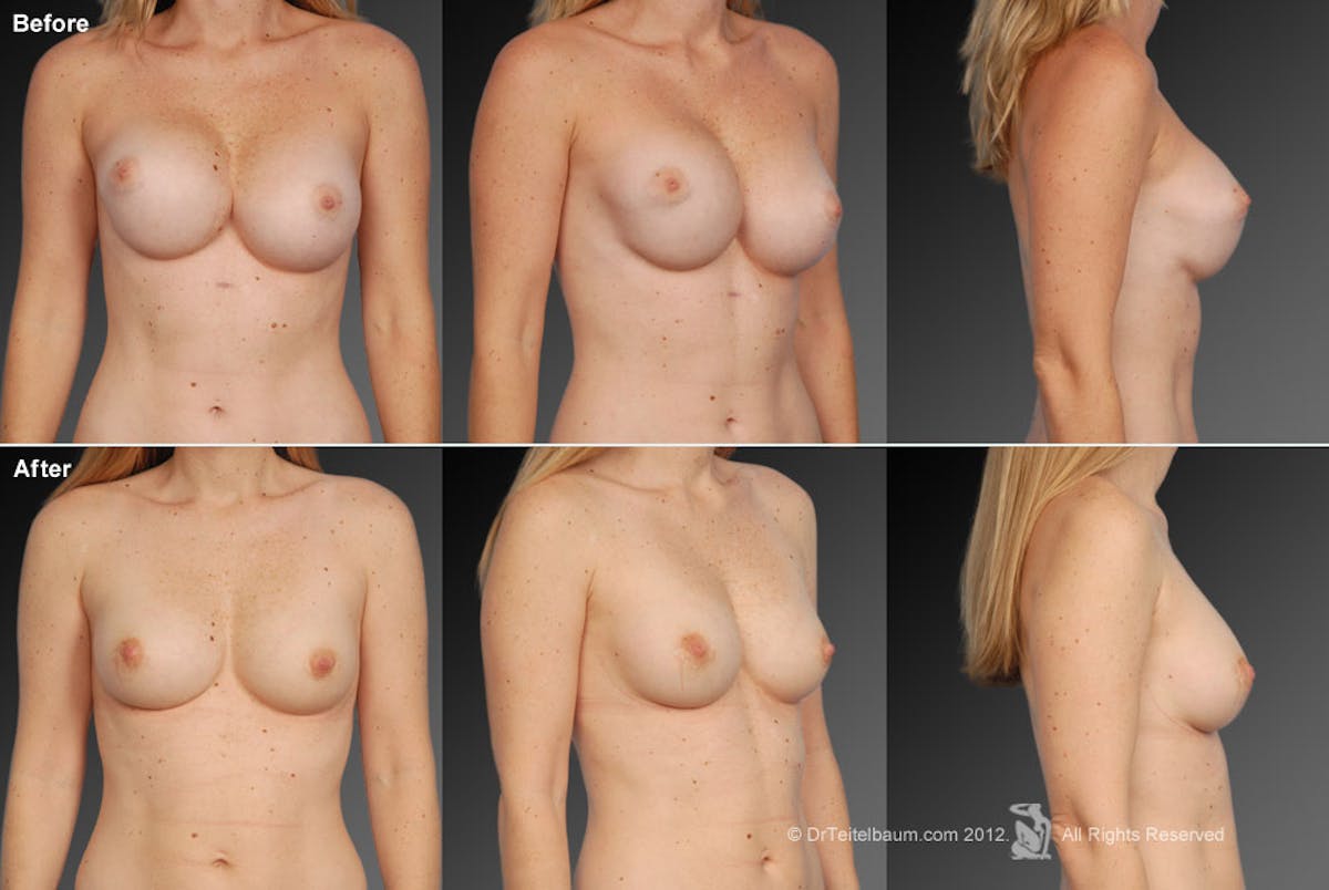 Breast Implant Revision Before & After Gallery - Patient 105536490 - Image 1