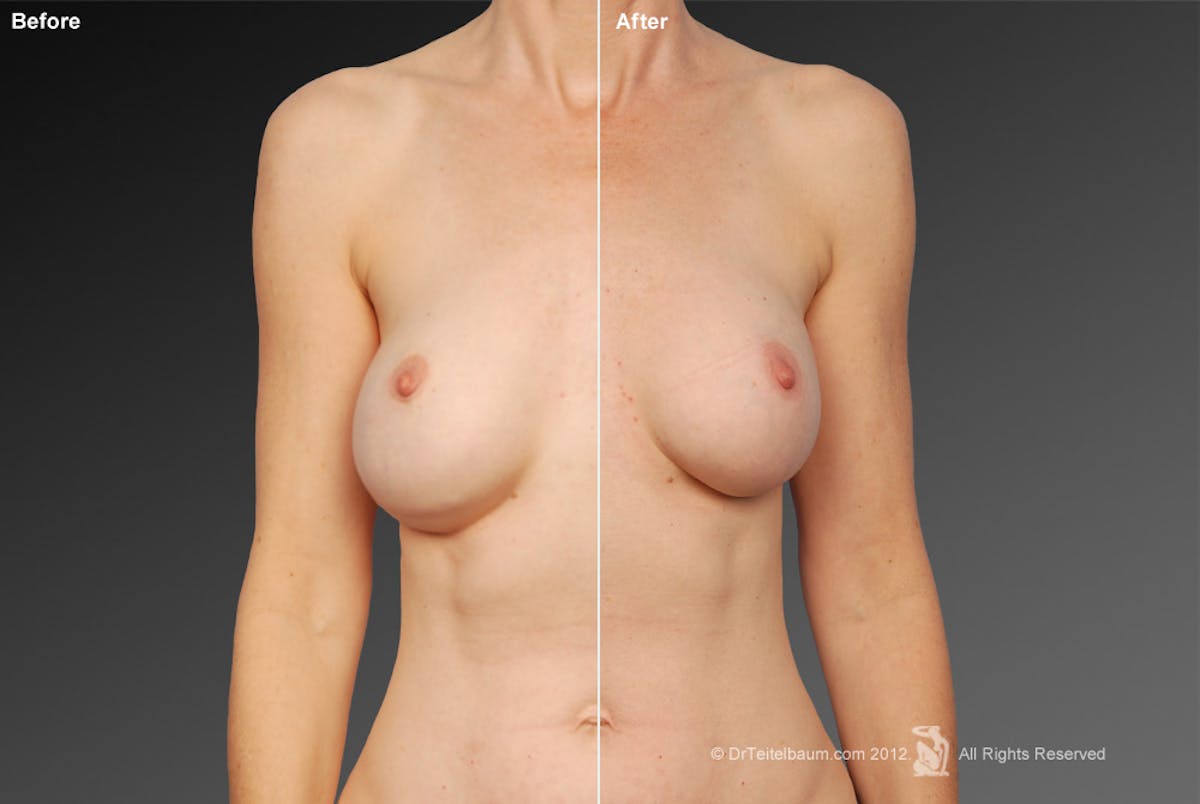 Breast Implant Revision Before & After Gallery - Patient 105536497 - Image 1