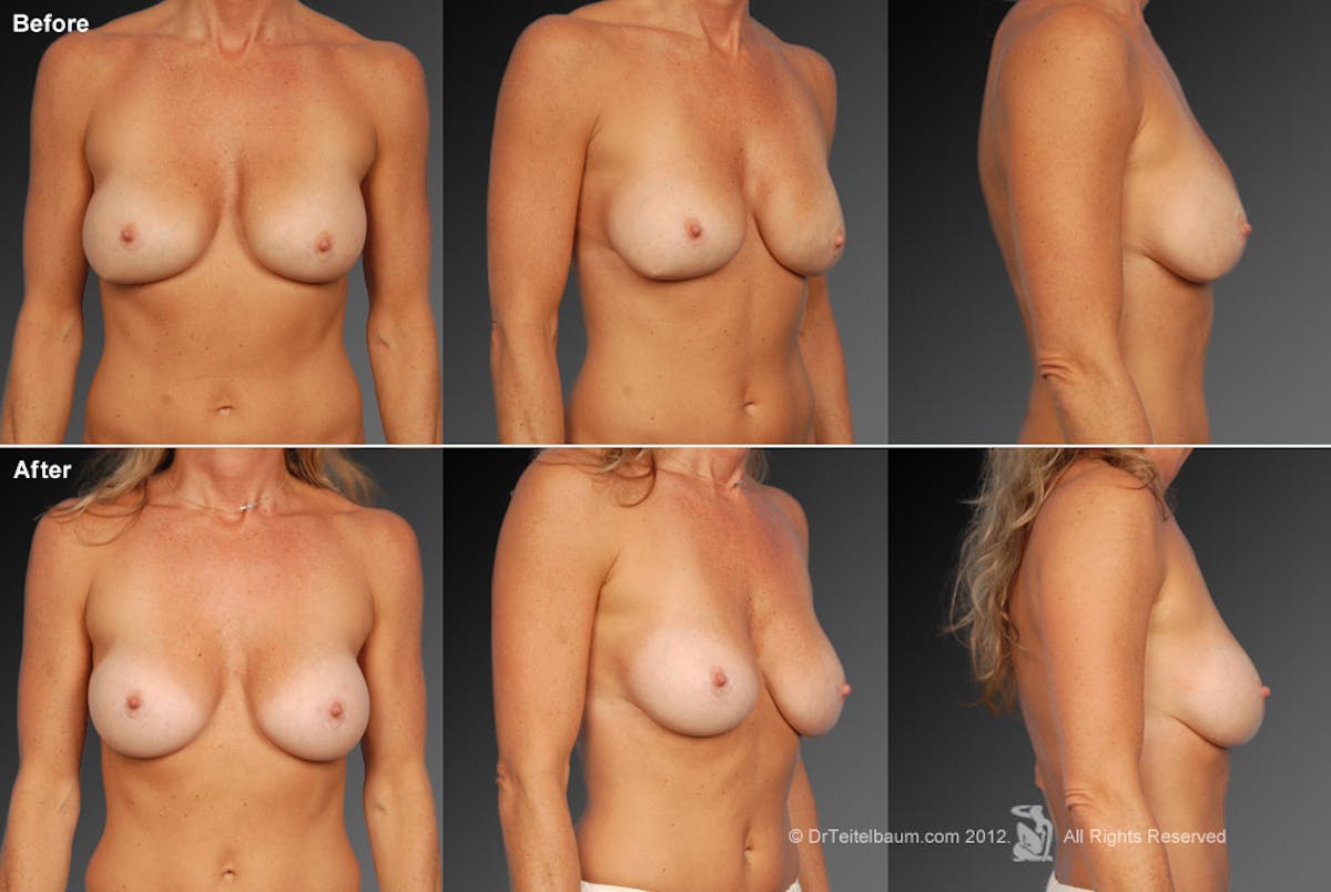 Breast Implant Revision Before & After Gallery - Patient 105536506 - Image 1