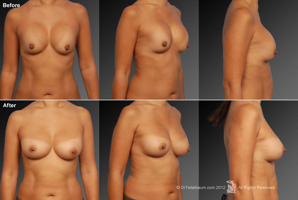 Breast Implant Revision Before & After Gallery - Patient 105536512 - Image 1