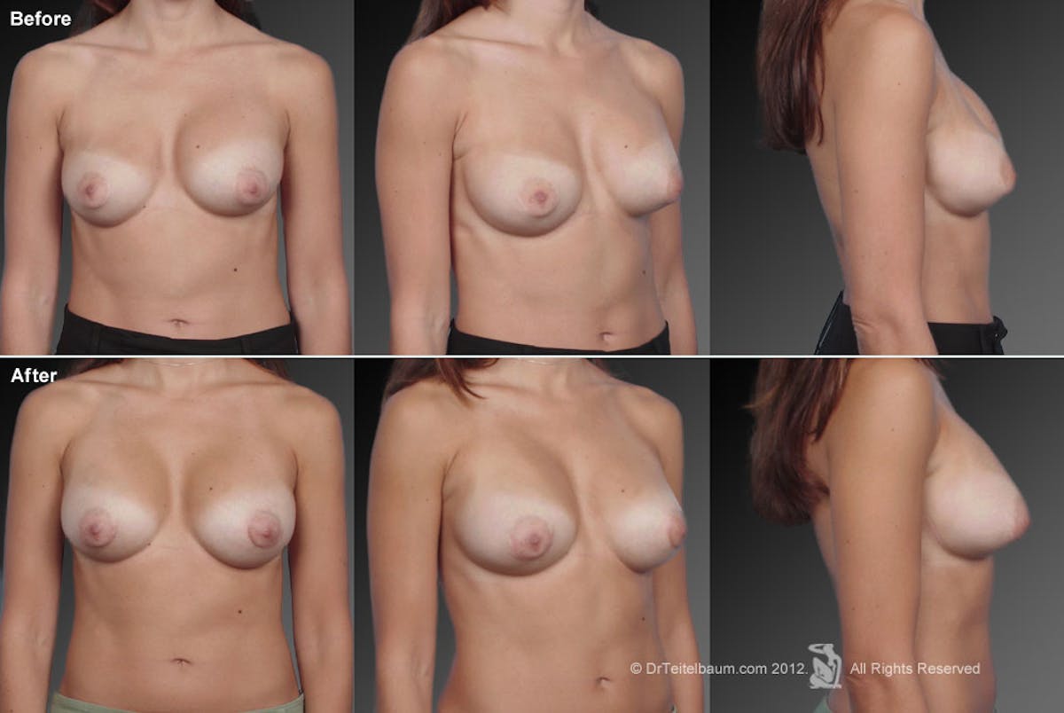 Breast Implant Revision Before & After Gallery - Patient 105536527 - Image 1