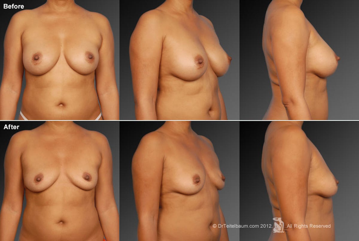 Breast Implant Revision Before & After Gallery - Patient 105536528 - Image 1