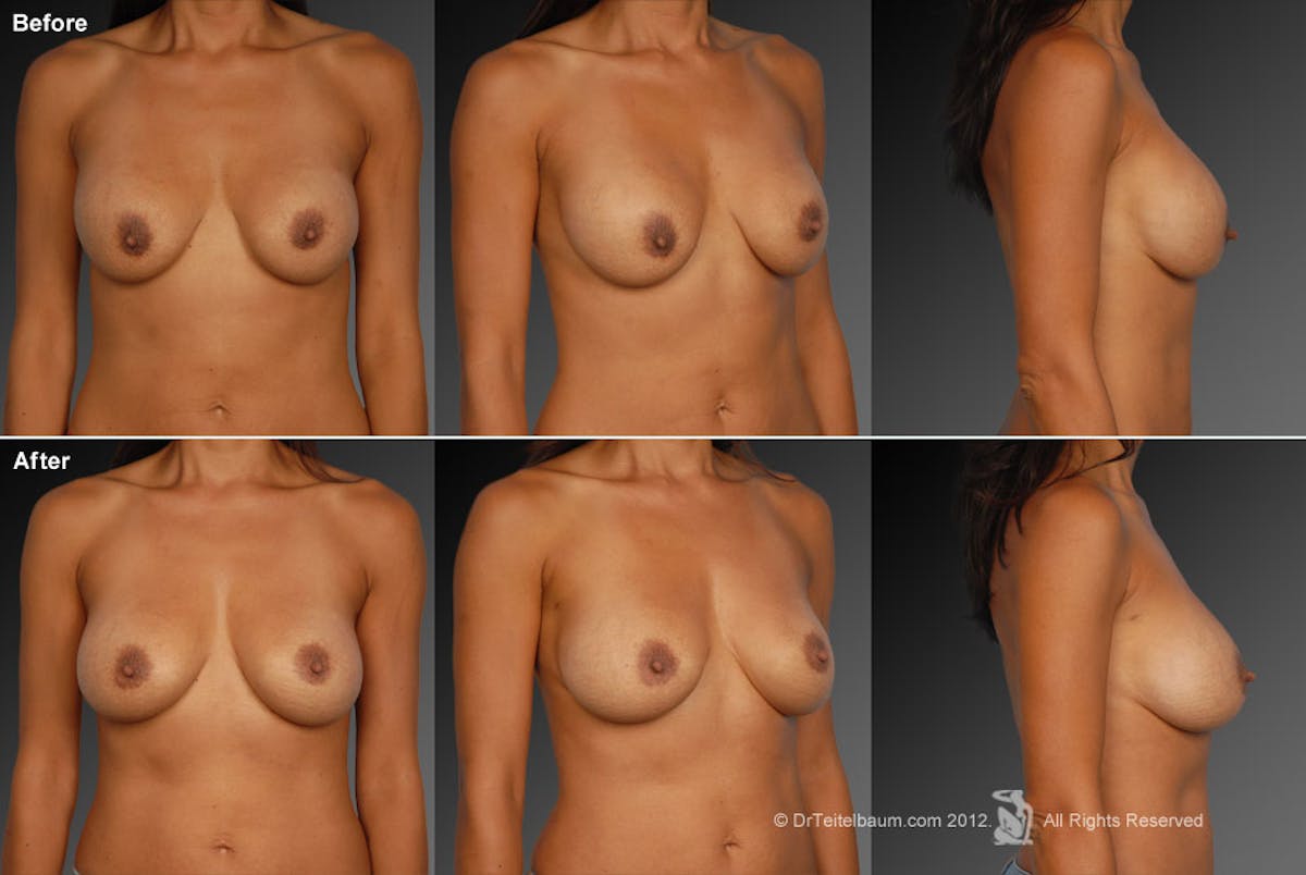 Breast Implant Revision Before & After Gallery - Patient 105554423 - Image 1