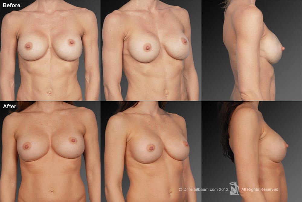 Breast Implant Revision Before & After Gallery - Patient 105554502 - Image 1