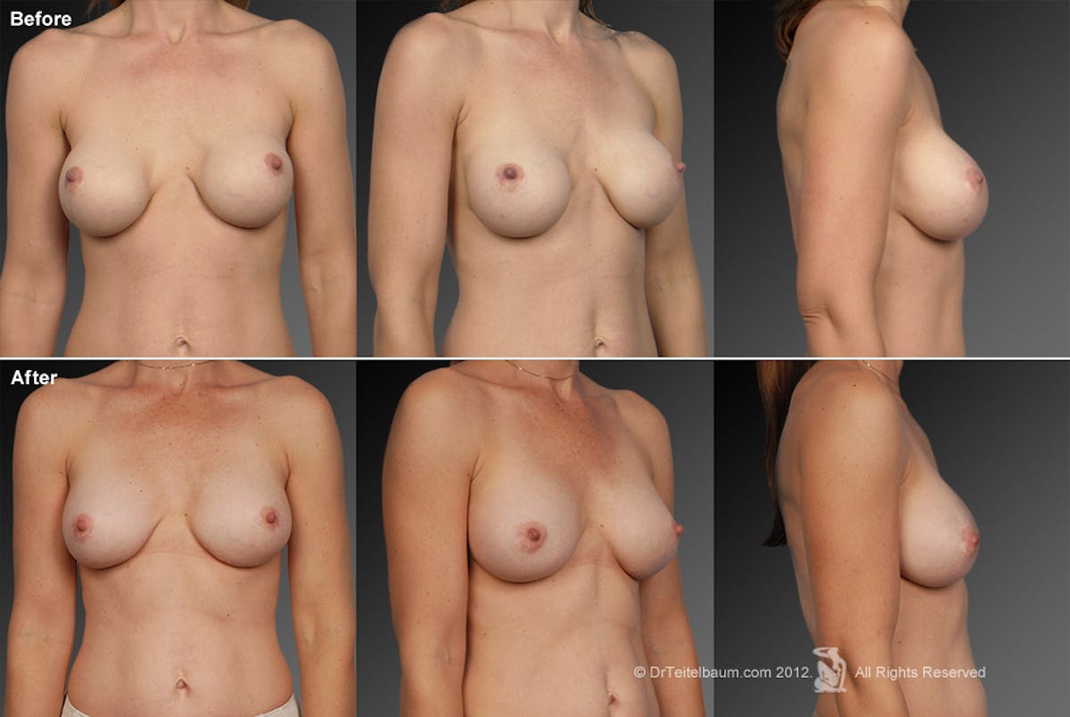 Breast Implant Revision Before & After Gallery - Patient 105554514 - Image 1