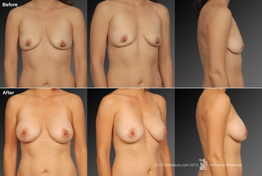 Breast Implant Revision Before & After Gallery - Patient 105554526 - Image 1