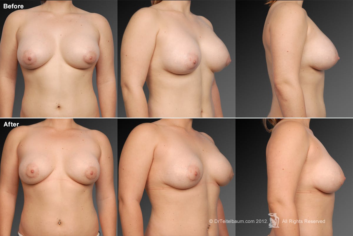 Breast Implant Revision Before & After Gallery - Patient 105554531 - Image 1