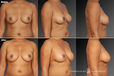 Breast Implant Revision Before & After Gallery - Patient 105554533 - Image 1