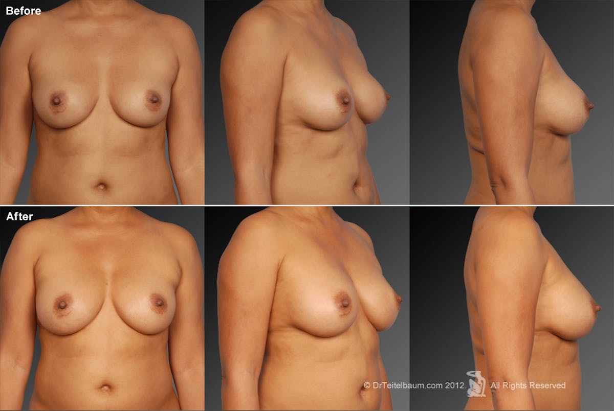 Breast Implant Revision Before & After Gallery - Patient 105554533 - Image 1