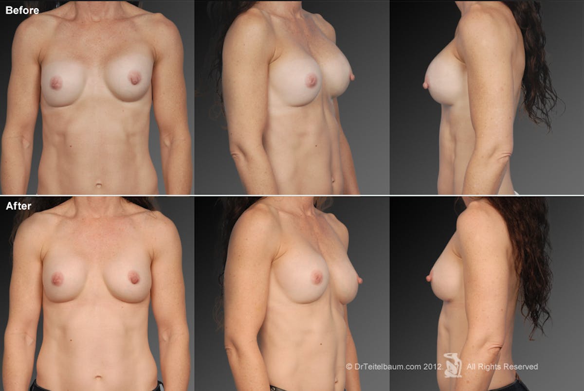 Breast Implant Revision Before & After Gallery - Patient 105554561 - Image 1