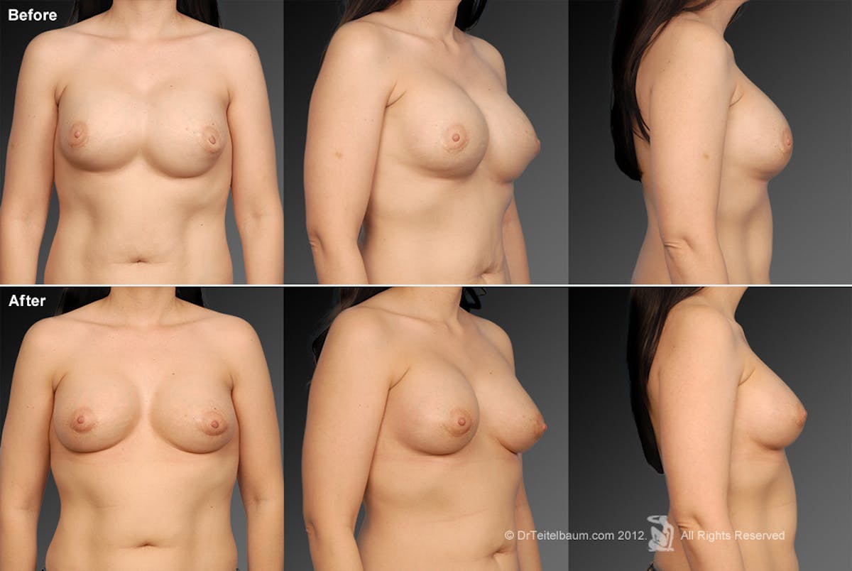 Breast Implant Revision Before & After Gallery - Patient 105554567 - Image 1