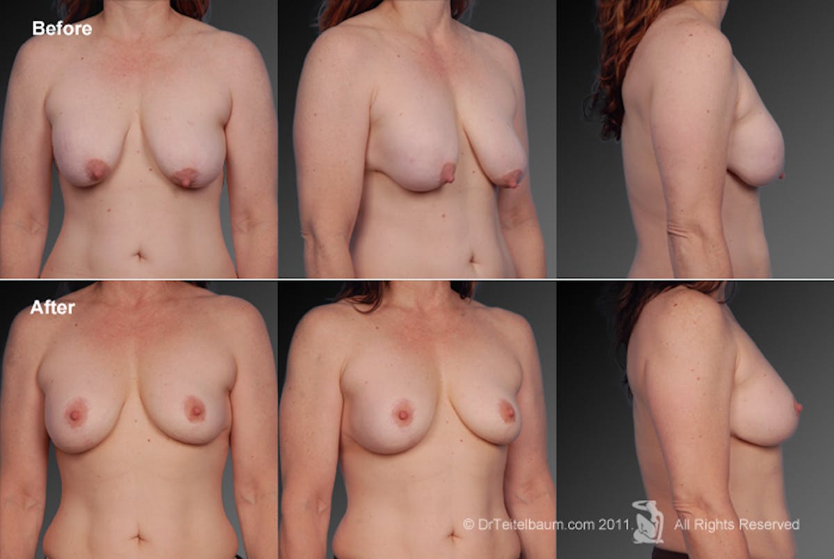 Breast Implant Revision Before & After Gallery - Patient 105554589 - Image 1