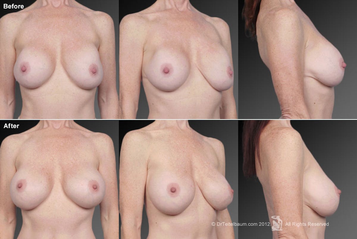Breast Implant Revision Before & After Gallery - Patient 105554592 - Image 1
