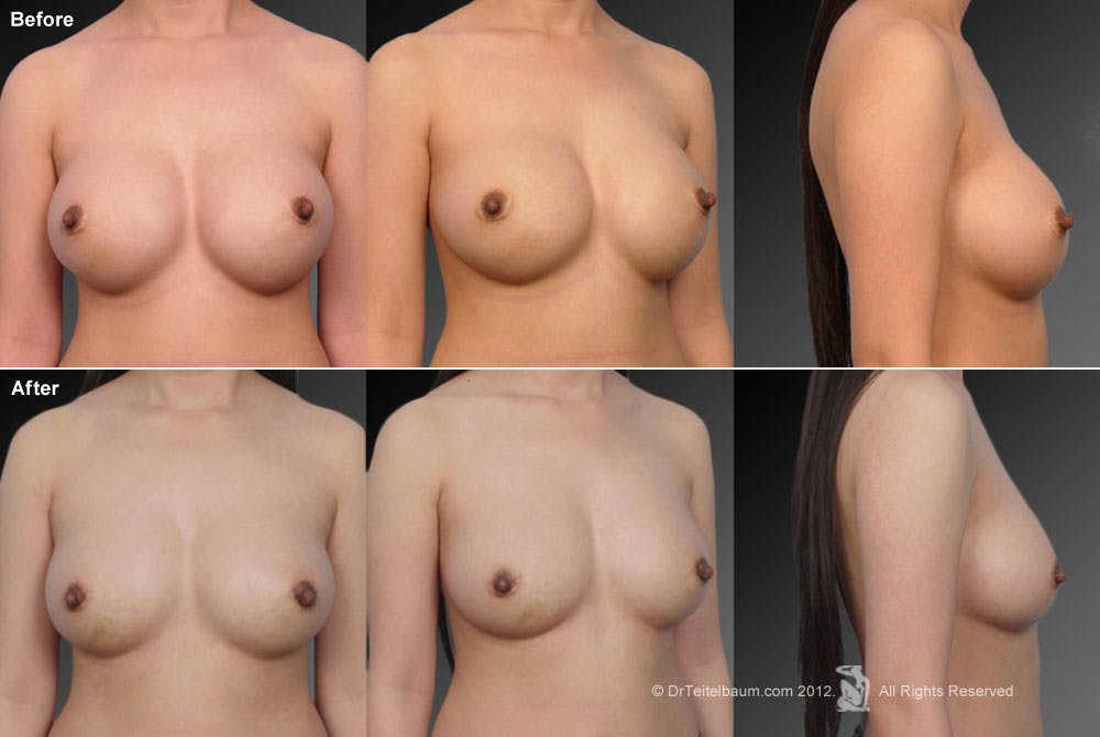 Breast Implant Revision Before & After Gallery - Patient 105554613 - Image 1