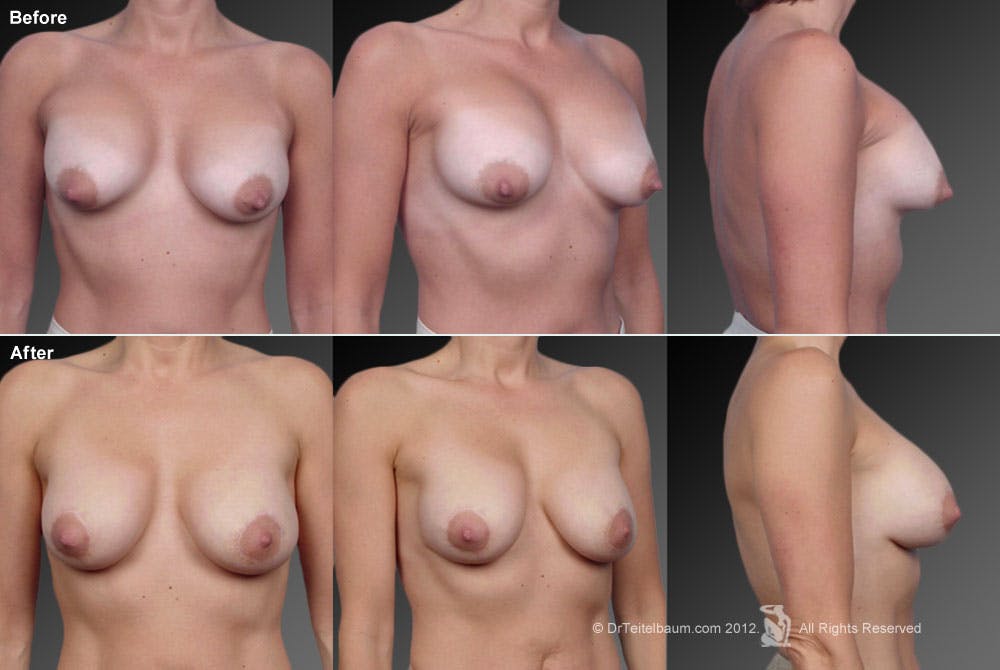 Breast Implant Revision Before & After Gallery - Patient 105554693 - Image 1