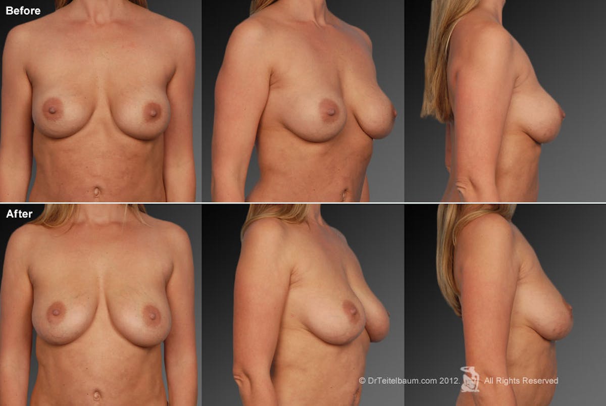 Breast Implant Revision Before & After Gallery - Patient 105554705 - Image 1