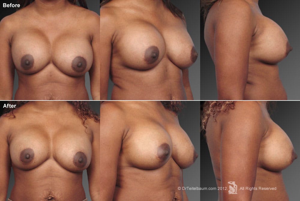 Breast Implant Revision Before & After Gallery - Patient 105554733 - Image 1
