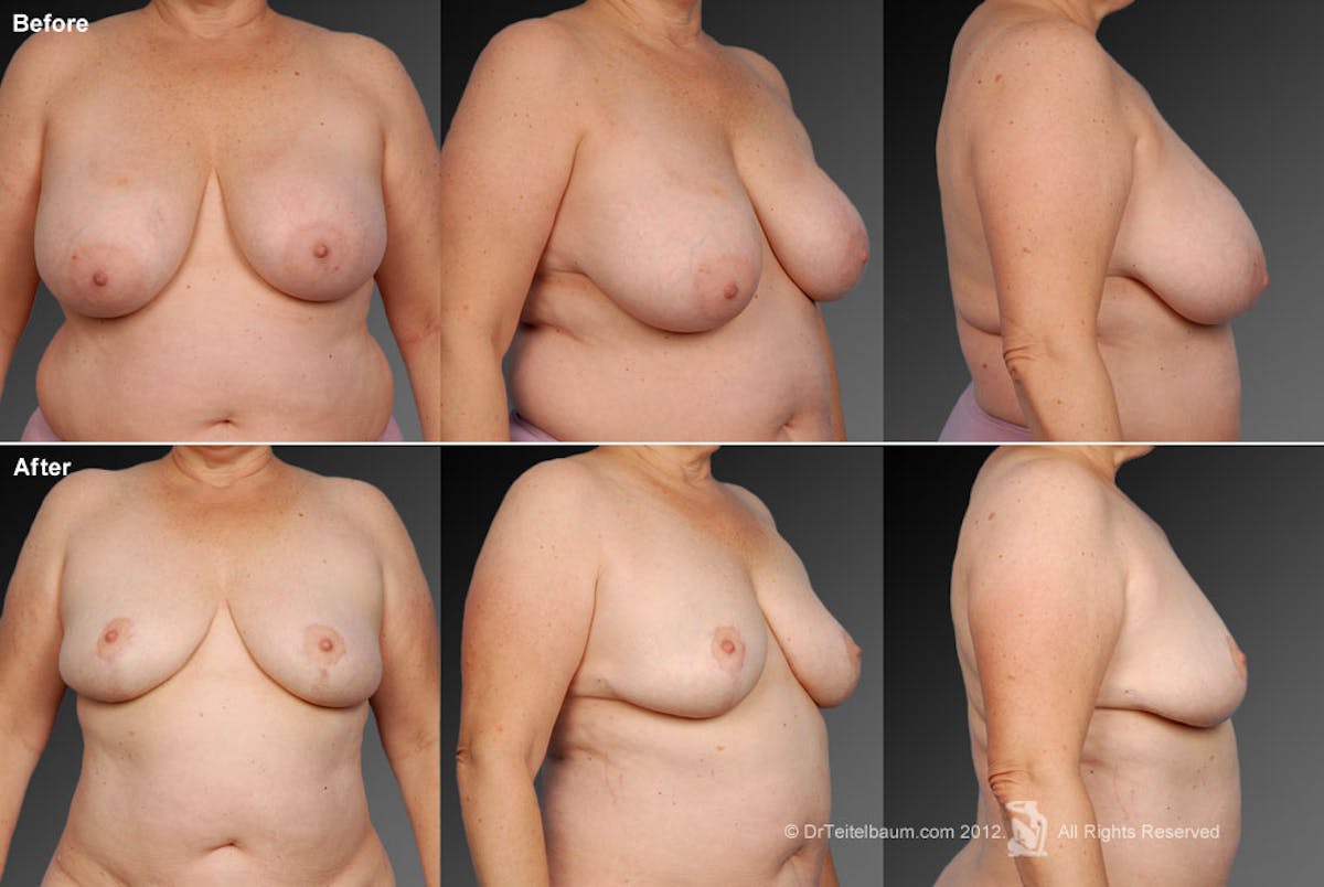 Breast Implant Revision Before & After Gallery - Patient 105554756 - Image 1