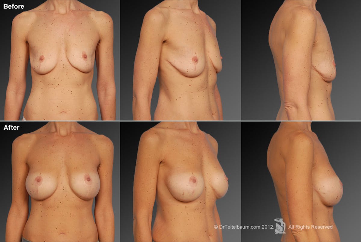 Breast Implant Revision Before & After Gallery - Patient 105554764 - Image 1