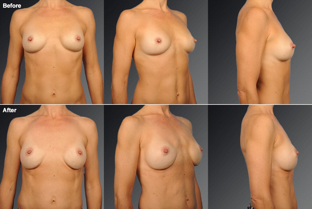 Breast Implant Revision Before & After Gallery - Patient 108616944 - Image 1