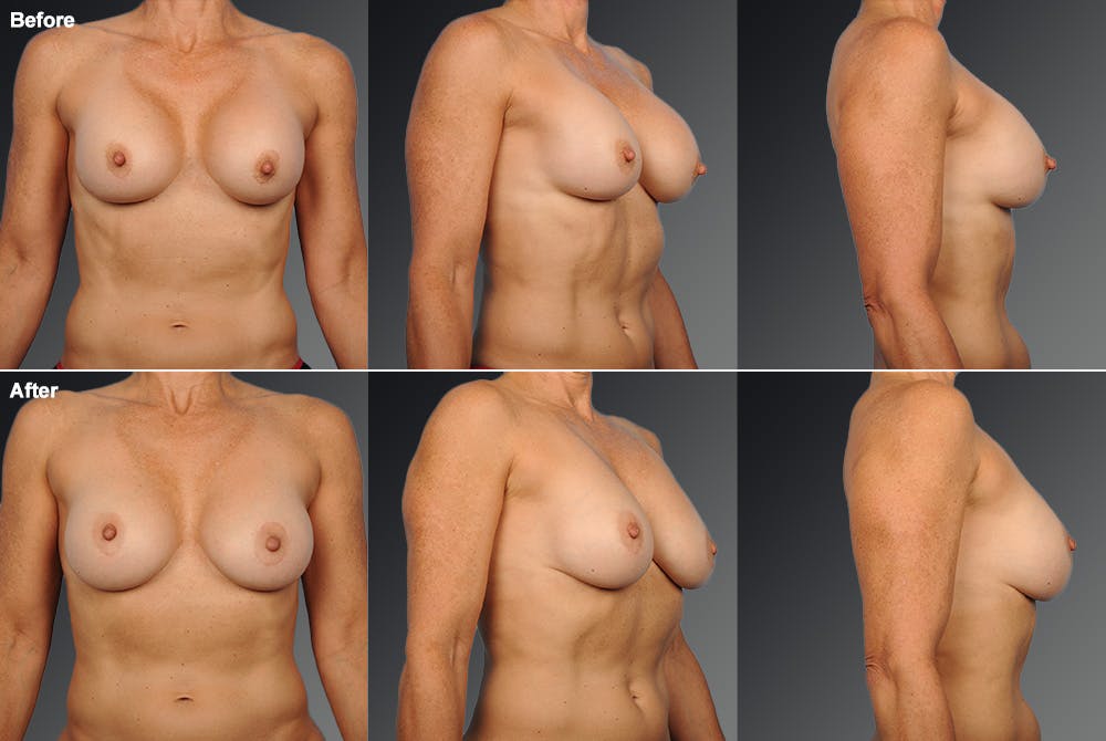 Breast Implant Revision Before & After Gallery - Patient 105600289 - Image 1