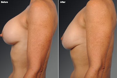 Breast Implant Revision Before & After Gallery - Patient 105600290 - Image 1