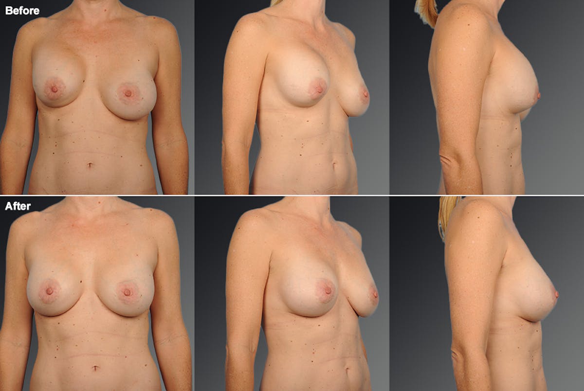 Breast Implant Revision Before & After Gallery - Patient 105600292 - Image 1