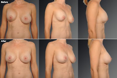Breast Implant Revision Before & After Gallery - Patient 105600292 - Image 1